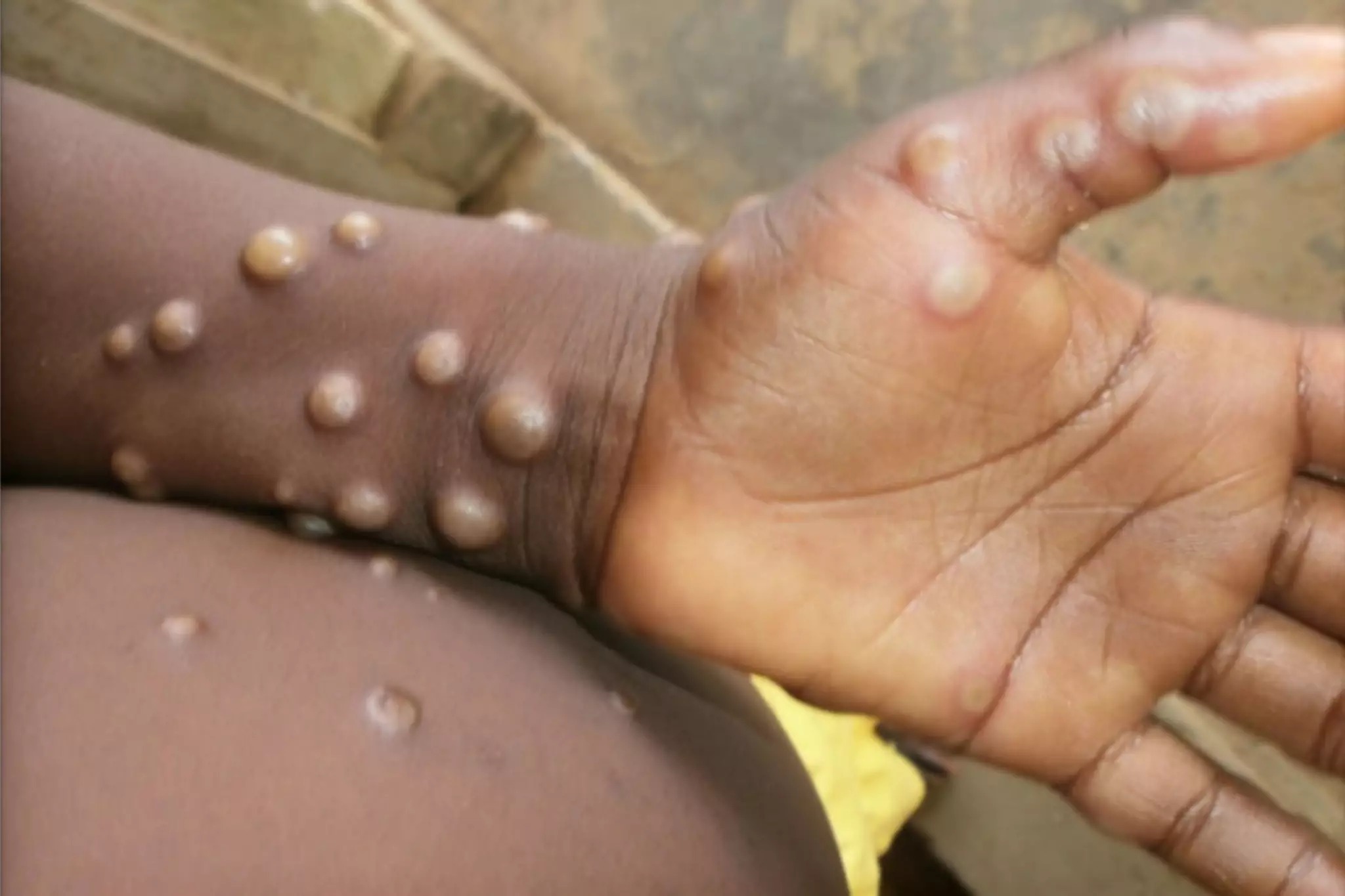 Mpox pustules