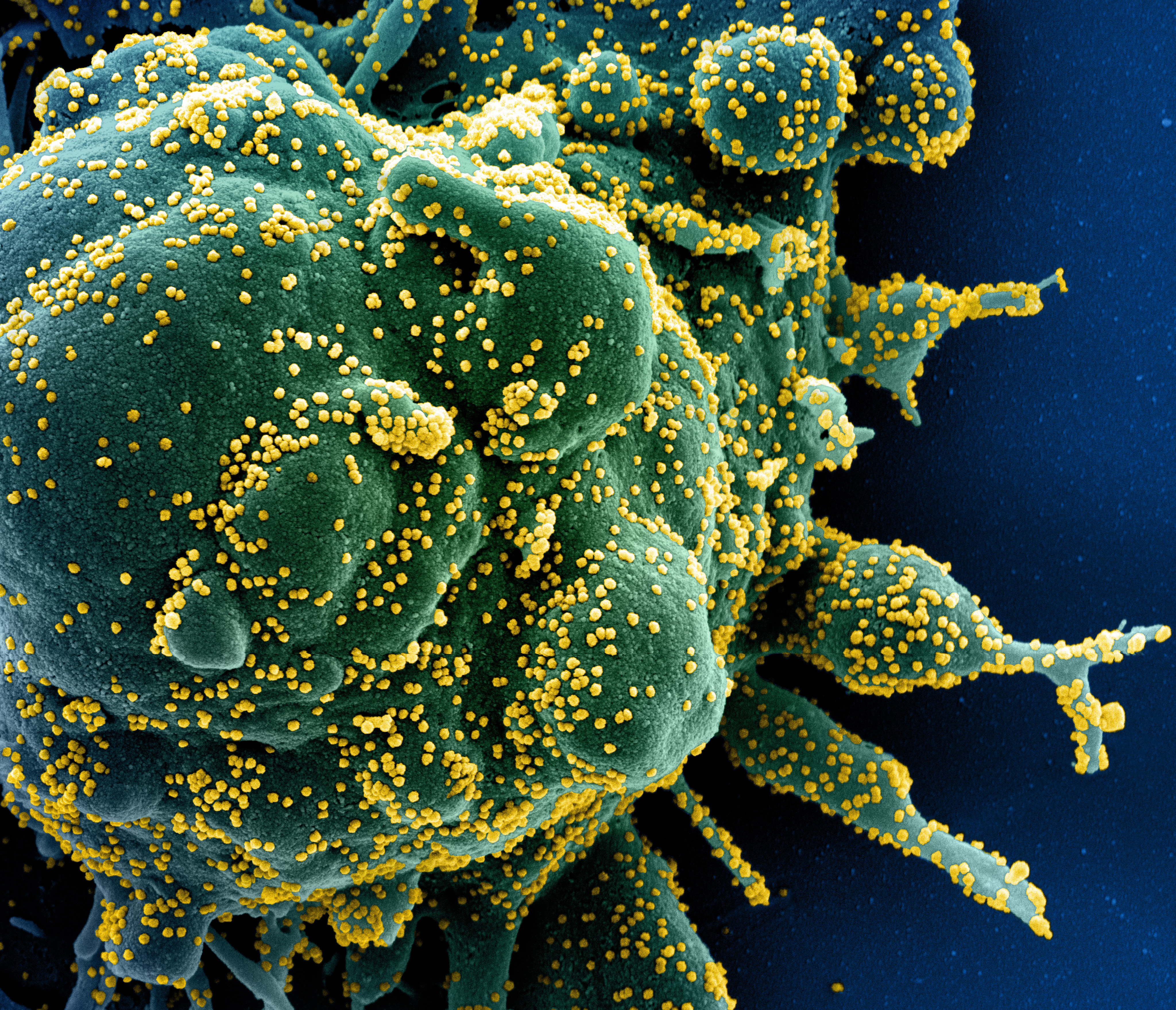 Cell infected with SARS-CoV-2, the virus that causes COVID-19, seen under an electron microscope